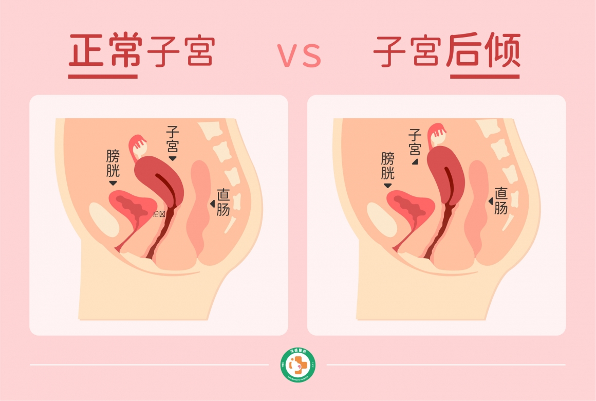 关于子宫切除的小秘密（一）——切除范围-搜狐