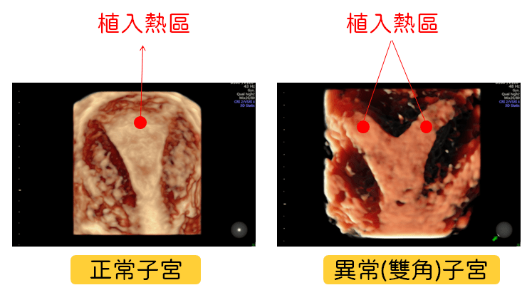 4D 超音波 助于医师判断胚胎植入位置