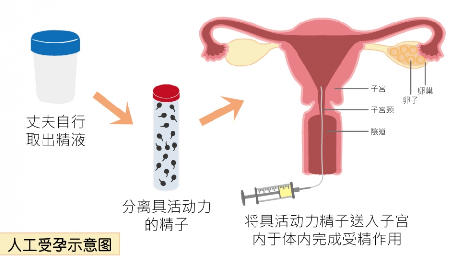 (簡)人工受孕示意圖