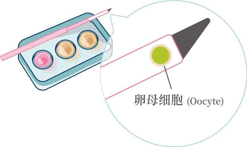 卵子冷凍技術流程(簡)