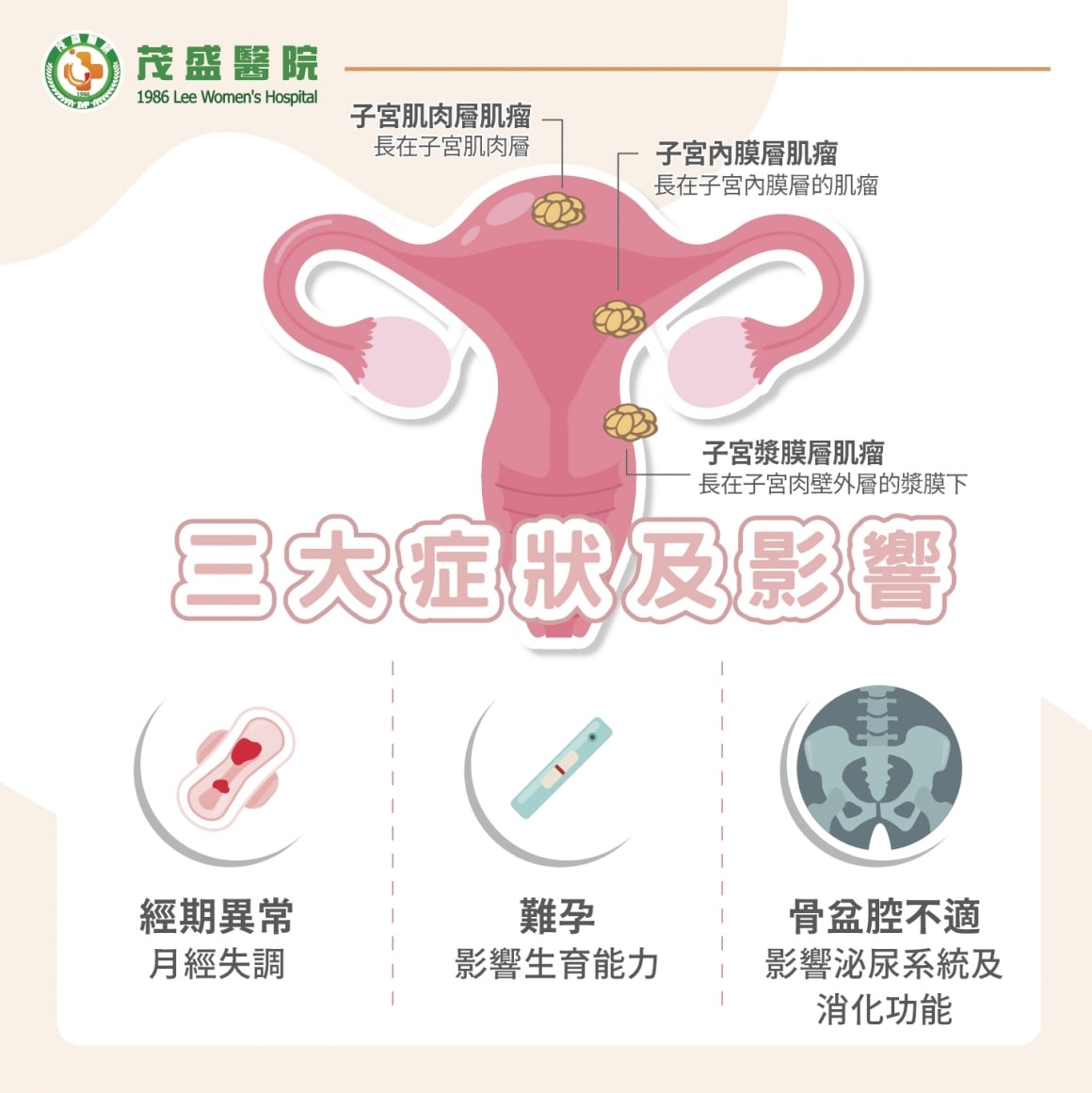 子宫肌瘤 子宫肌瘤症状